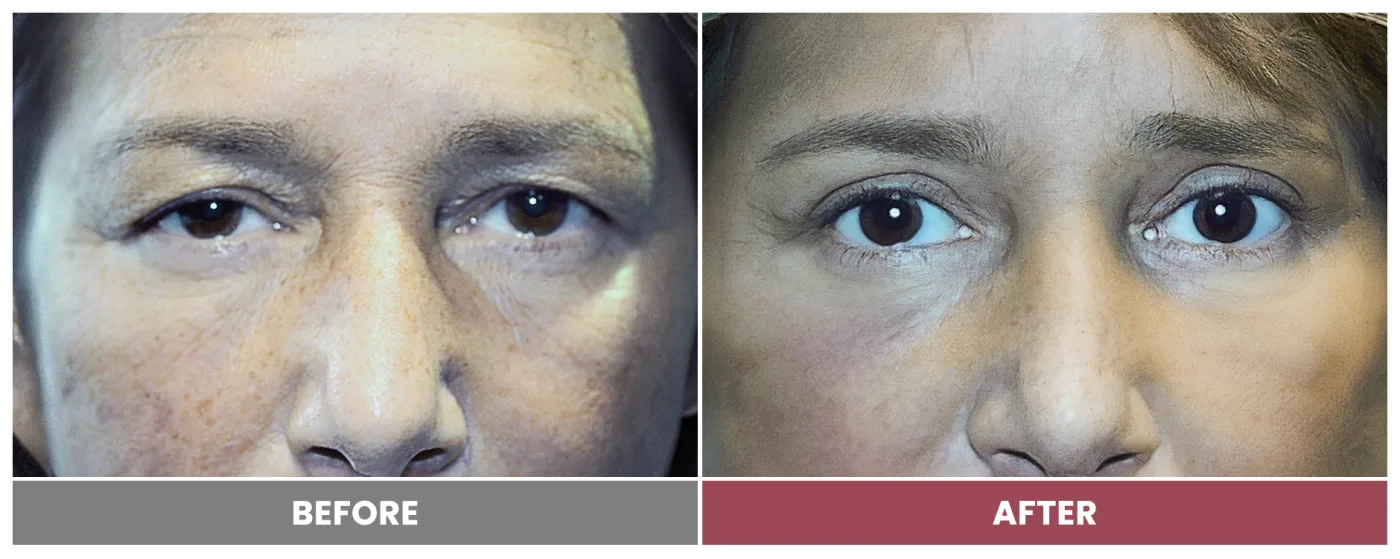Upper Blepharoplasty - Case 10