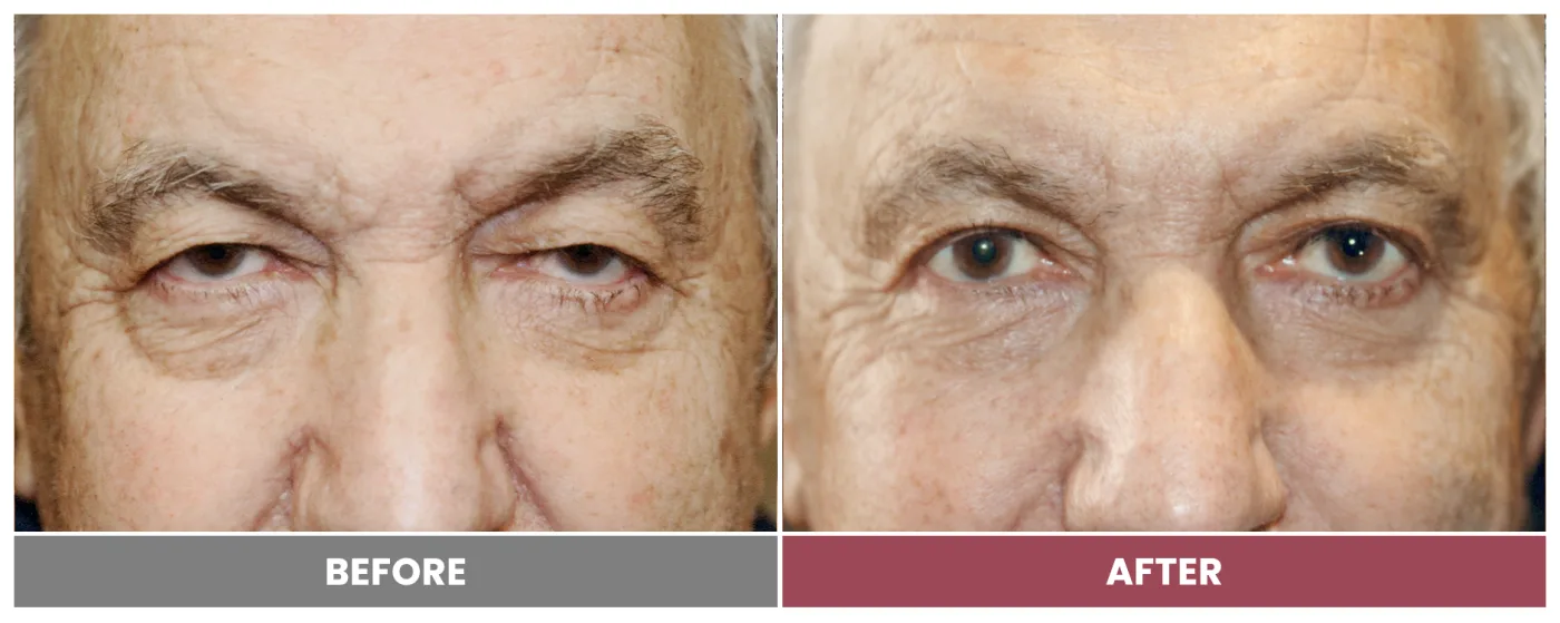 Upper Blepharoplasty - Case 103