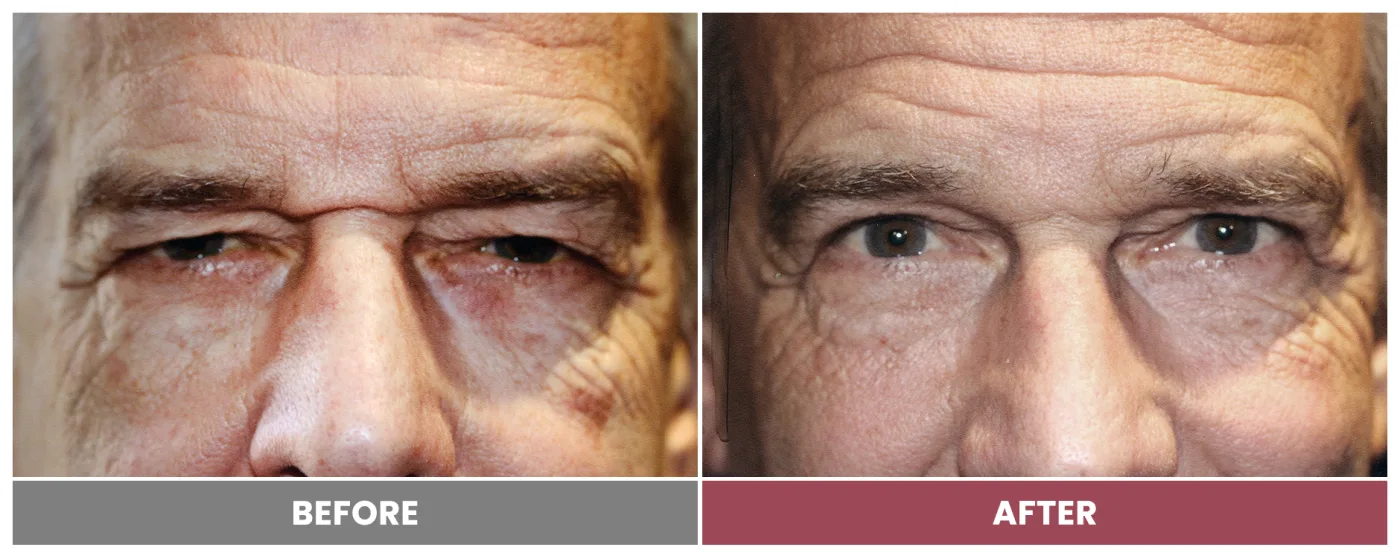 Upper Blepharoplasty - Case 106