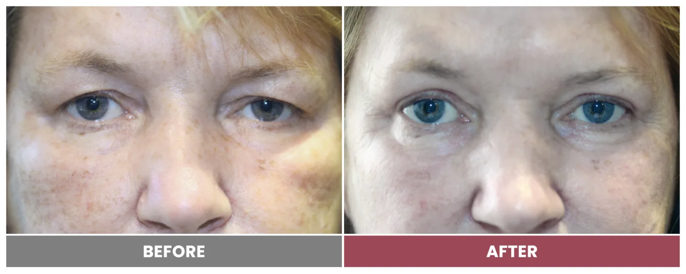 Upper Blepharoplasty - Case 107