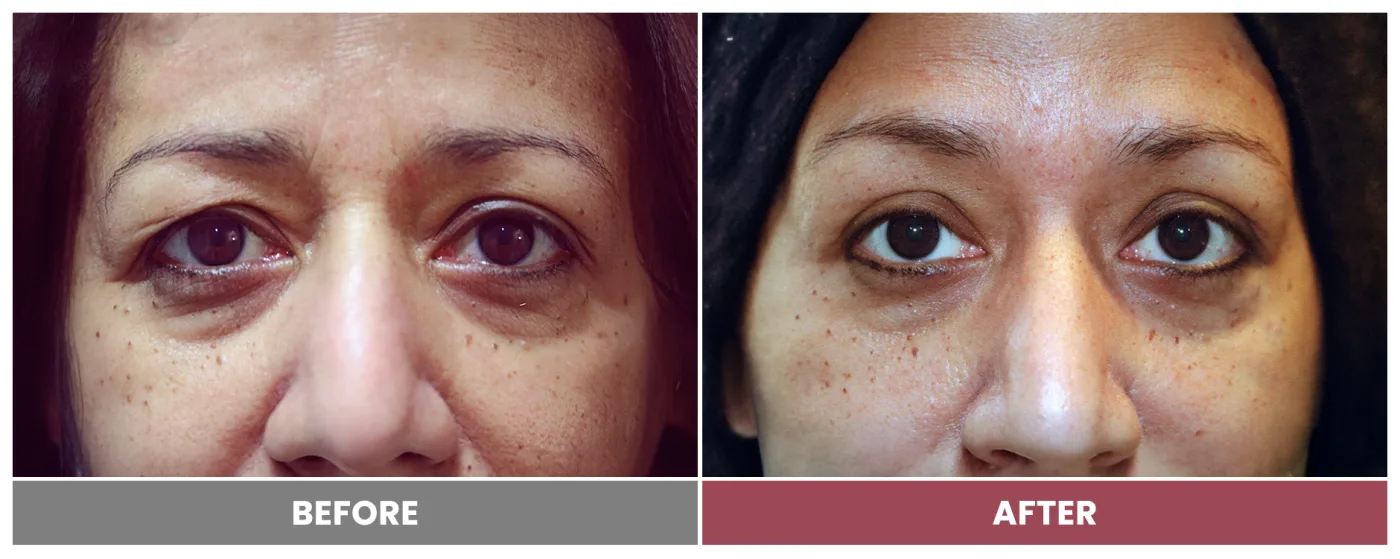 Upper Blepharoplasty - Case 108
