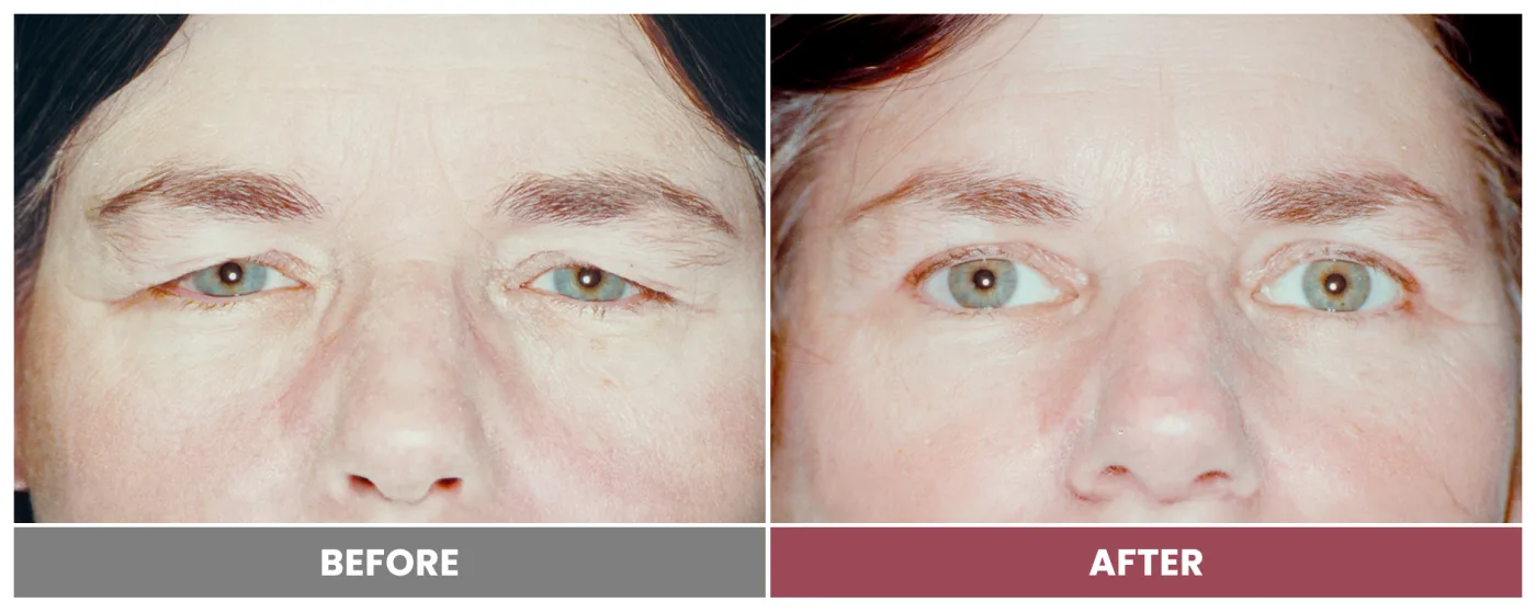 Upper Blepharoplasty - Case 109