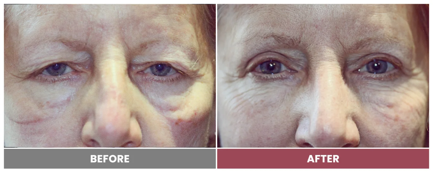 Upper Blepharoplasty - Case 11