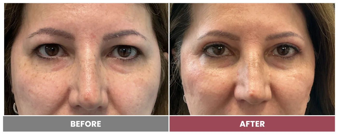 Upper Blepharoplasty - Case 110