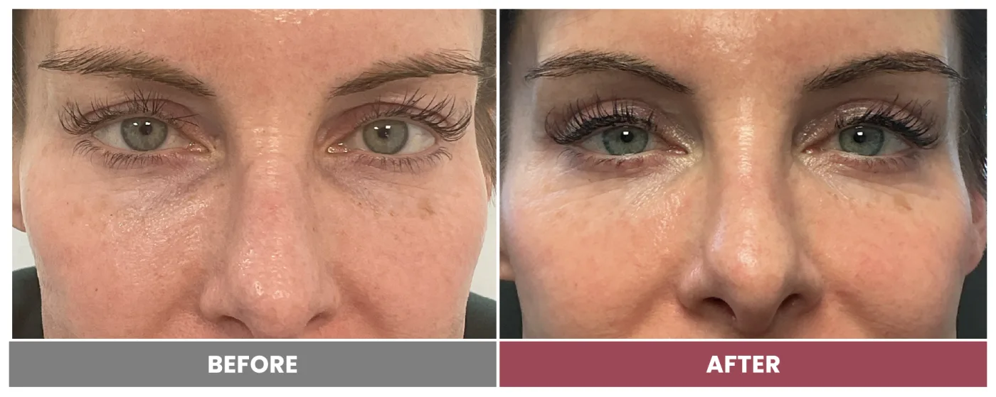 Upper Blepharoplasty - Case 111