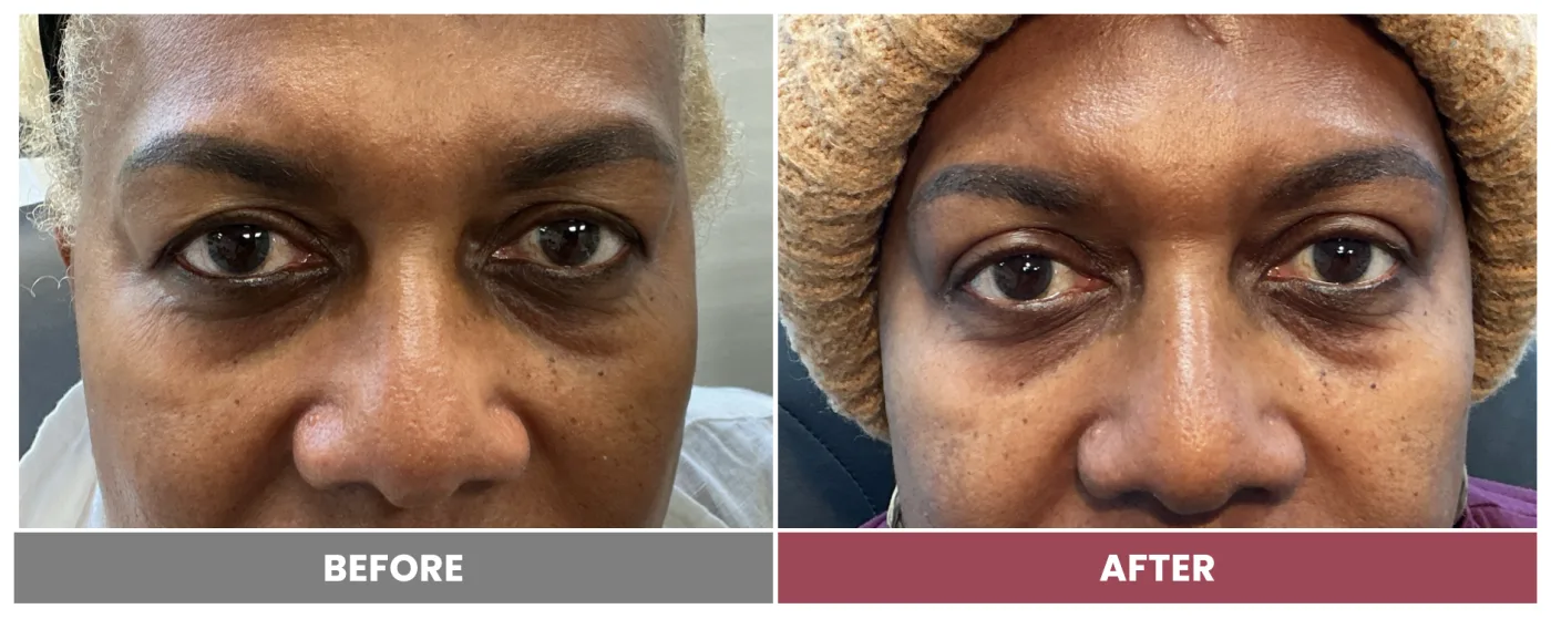 Upper Blepharoplasty - Case 112