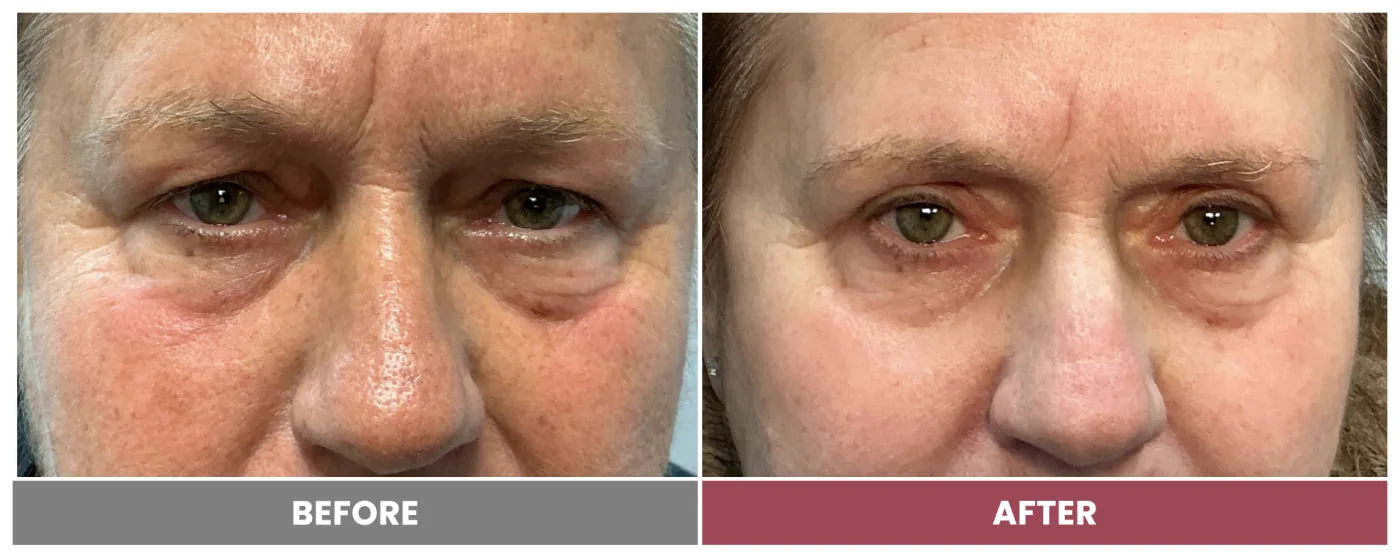 Upper Blepharoplasty - Case 113