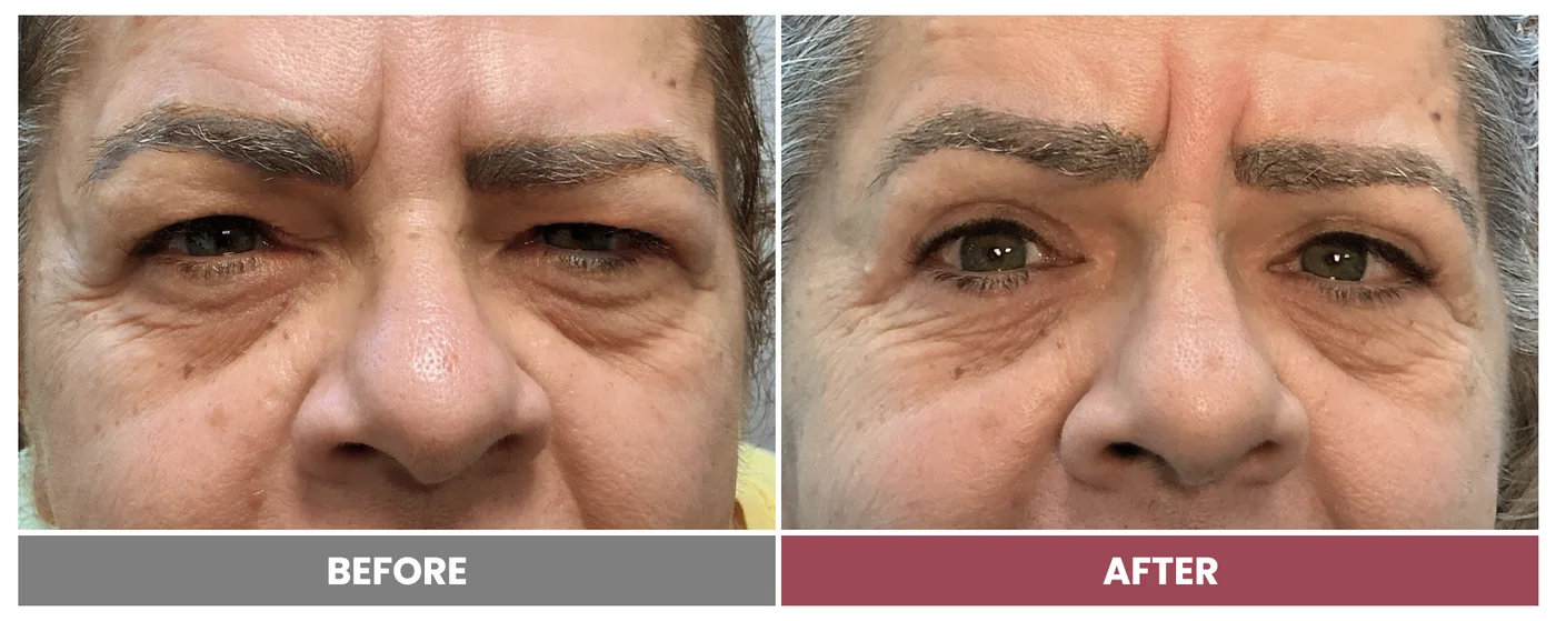Upper Blepharoplasty - Case 114