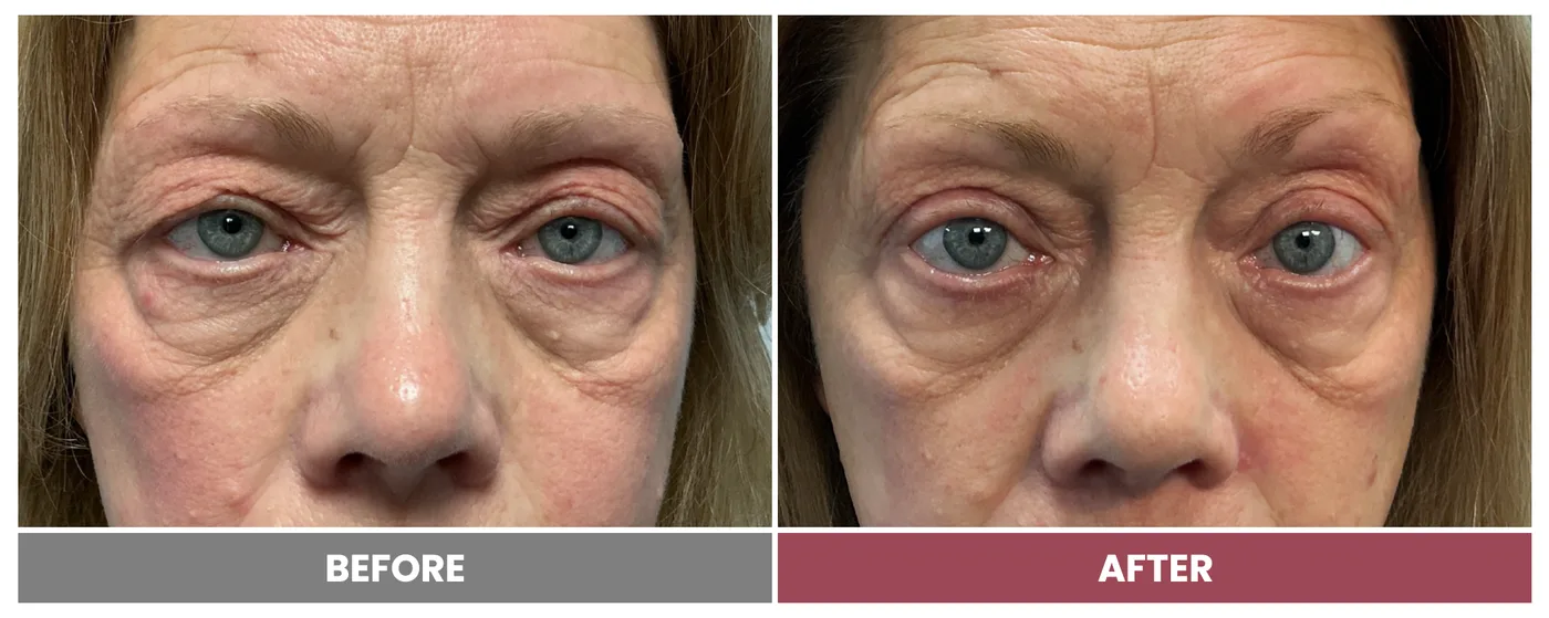 Upper Blepharoplasty - Case 115