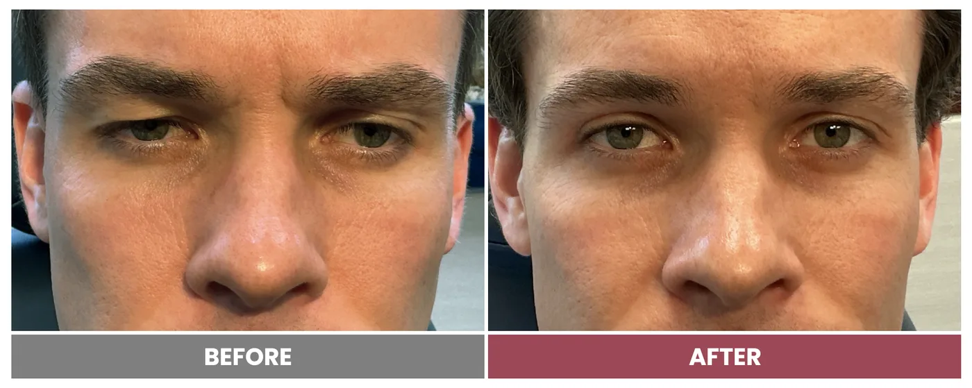 Upper Blepharoplasty - Case 116