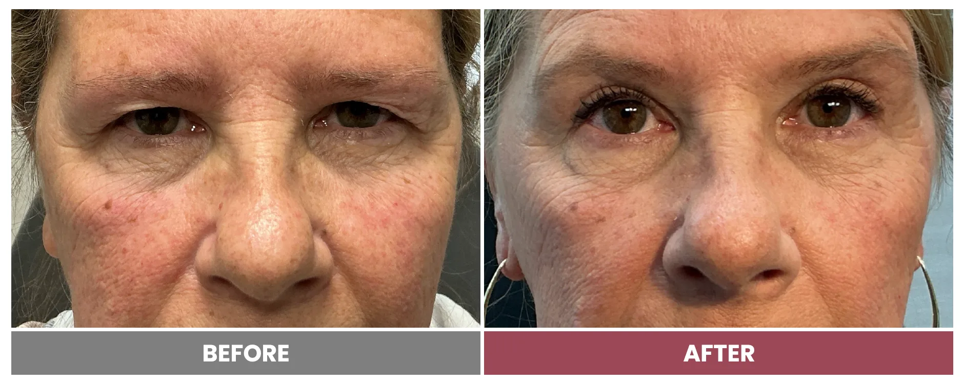 Upper Blepharoplasty - Case 117