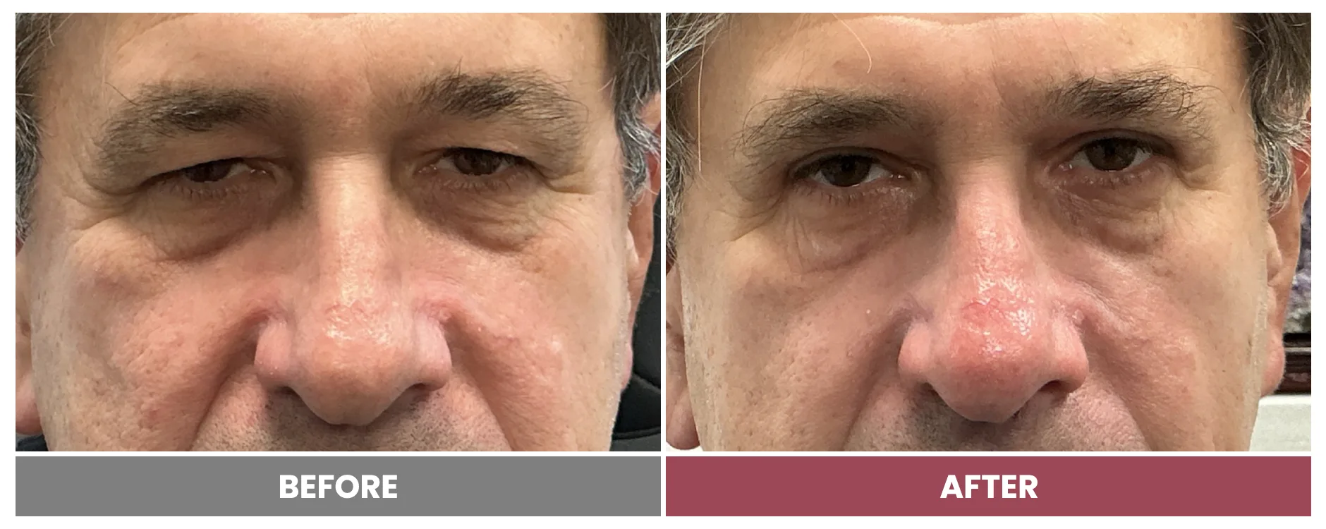 Upper Blepharoplasty - Case 118