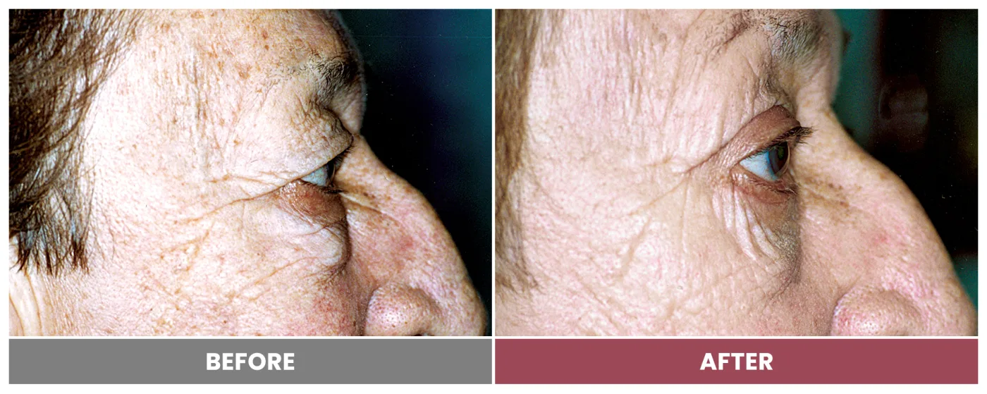 Upper Blepharoplasty - Case 13