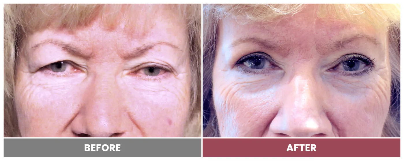 Upper Blepharoplasty - Case 15