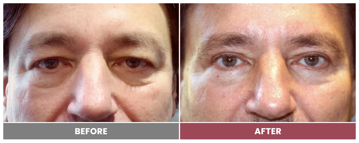 Upper Blepharoplasty - Case 16