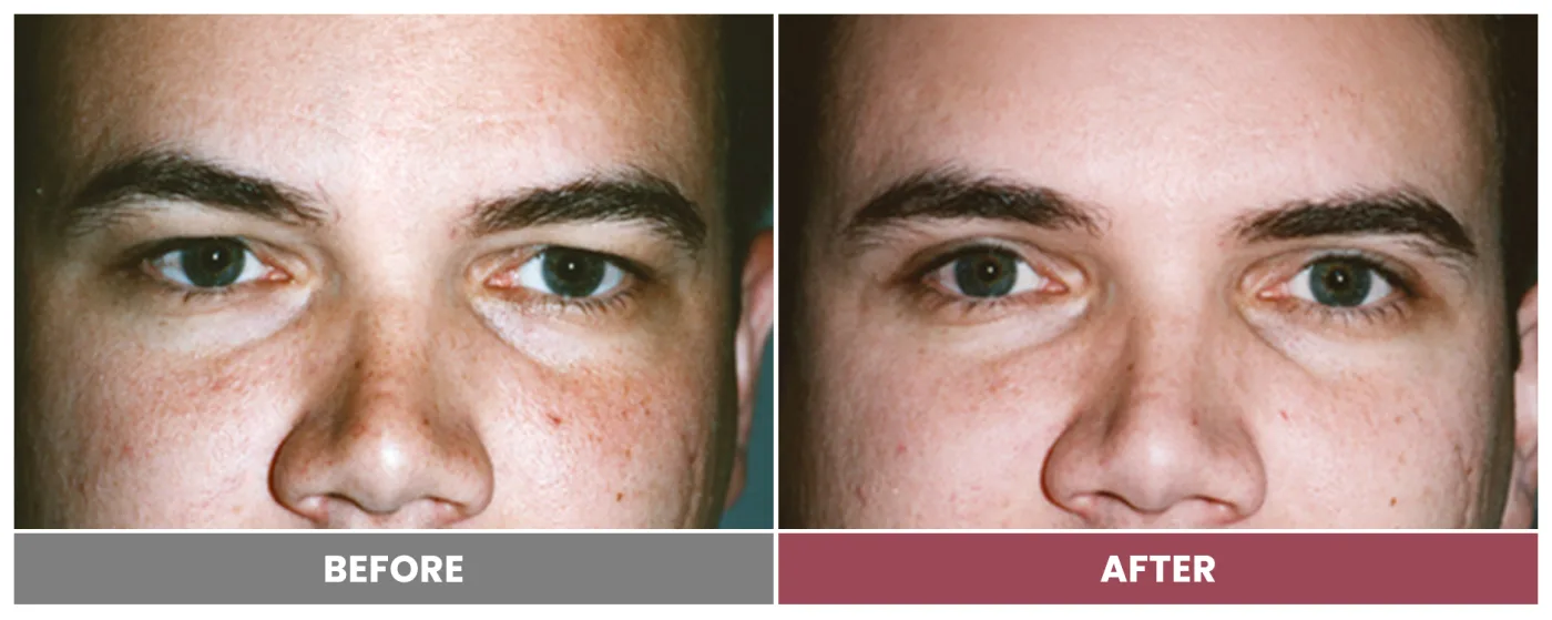 Upper Blepharoplasty - Case 19
