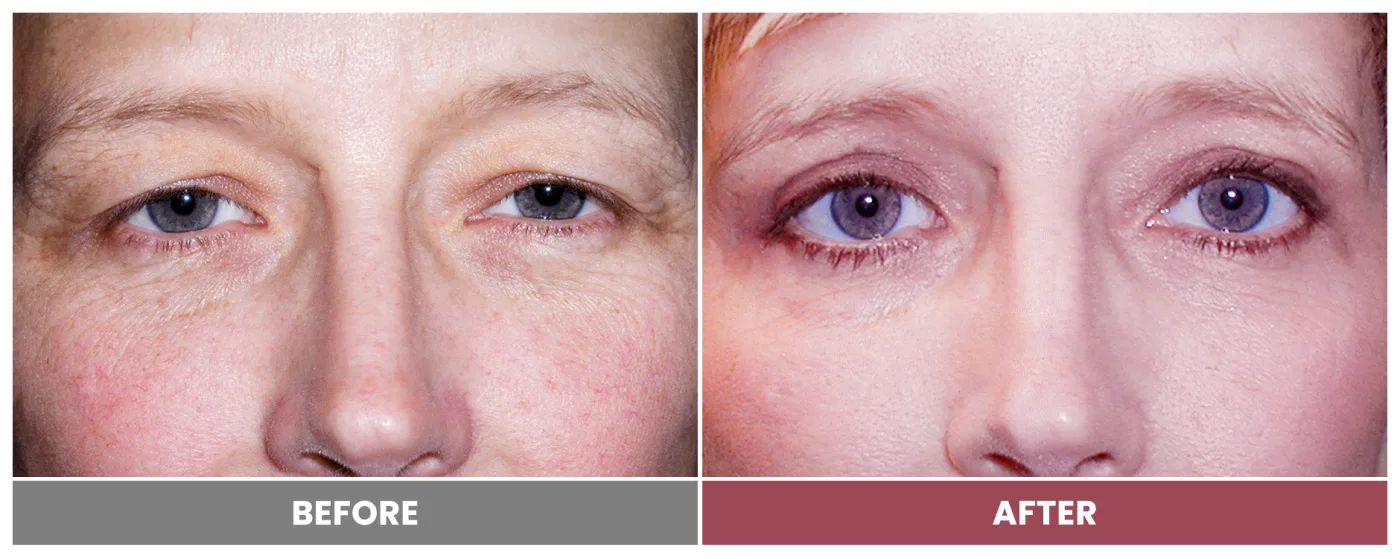 Upper Blepharoplasty - Case 22