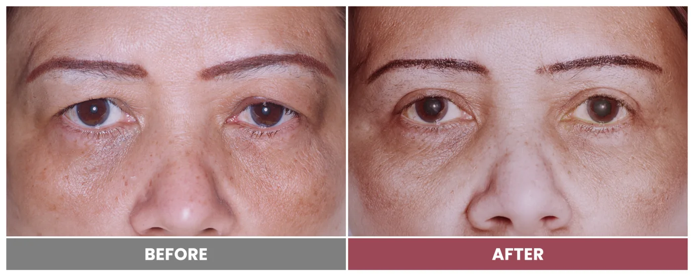 Upper Blepharoplasty - Case 23