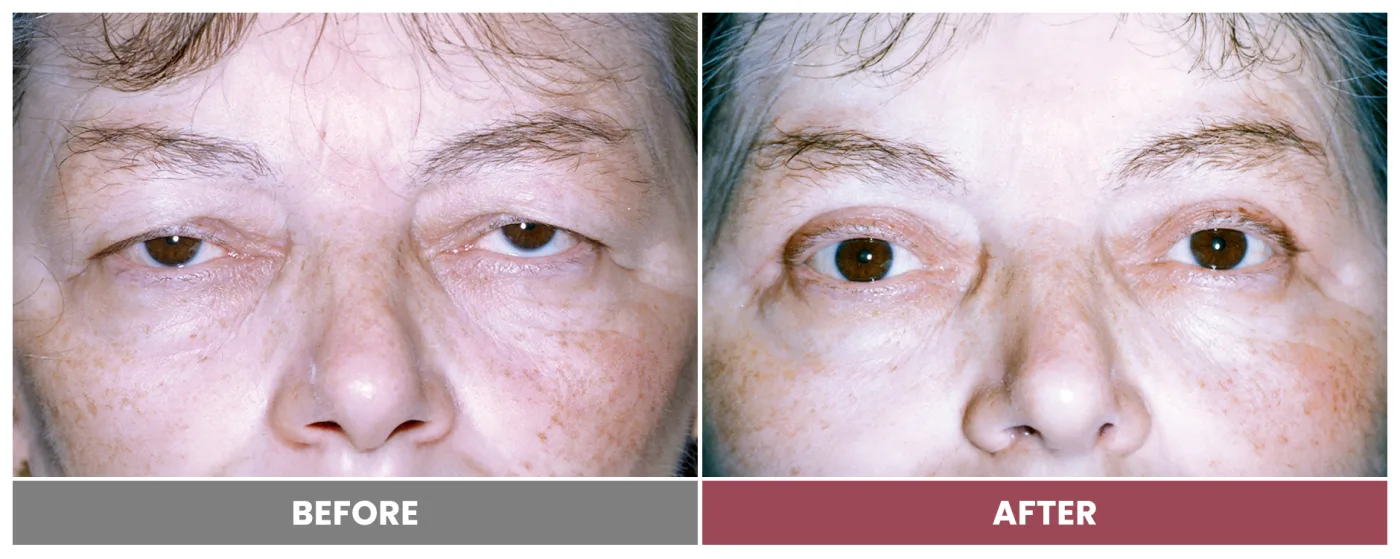 Upper Blepharoplasty - Case 30