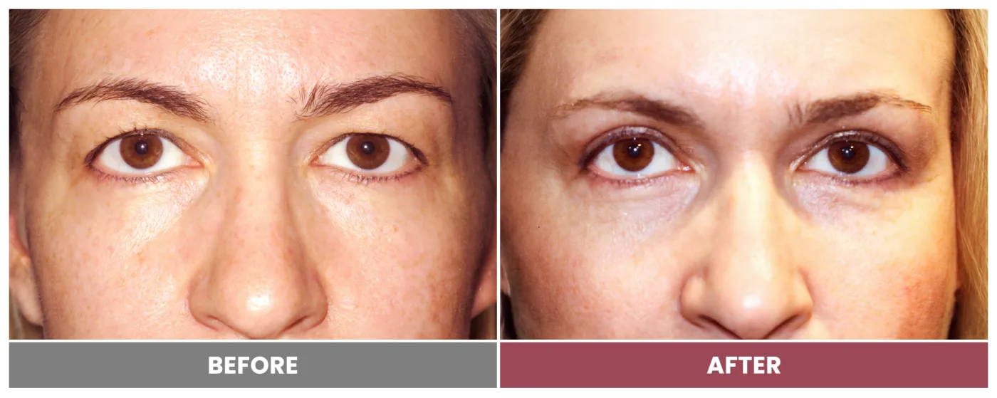 Upper Blepharoplasty - Case 35