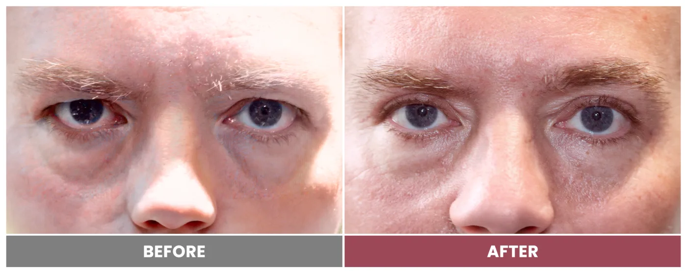 Upper Blepharoplasty - Case 38