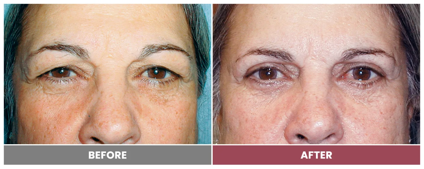 Upper Blepharoplasty - Case 4