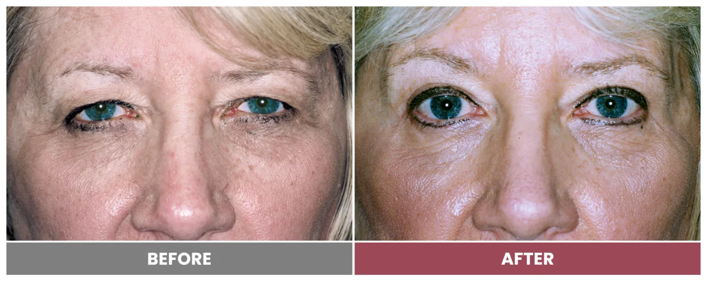 Upper Blepharoplasty - Case 40