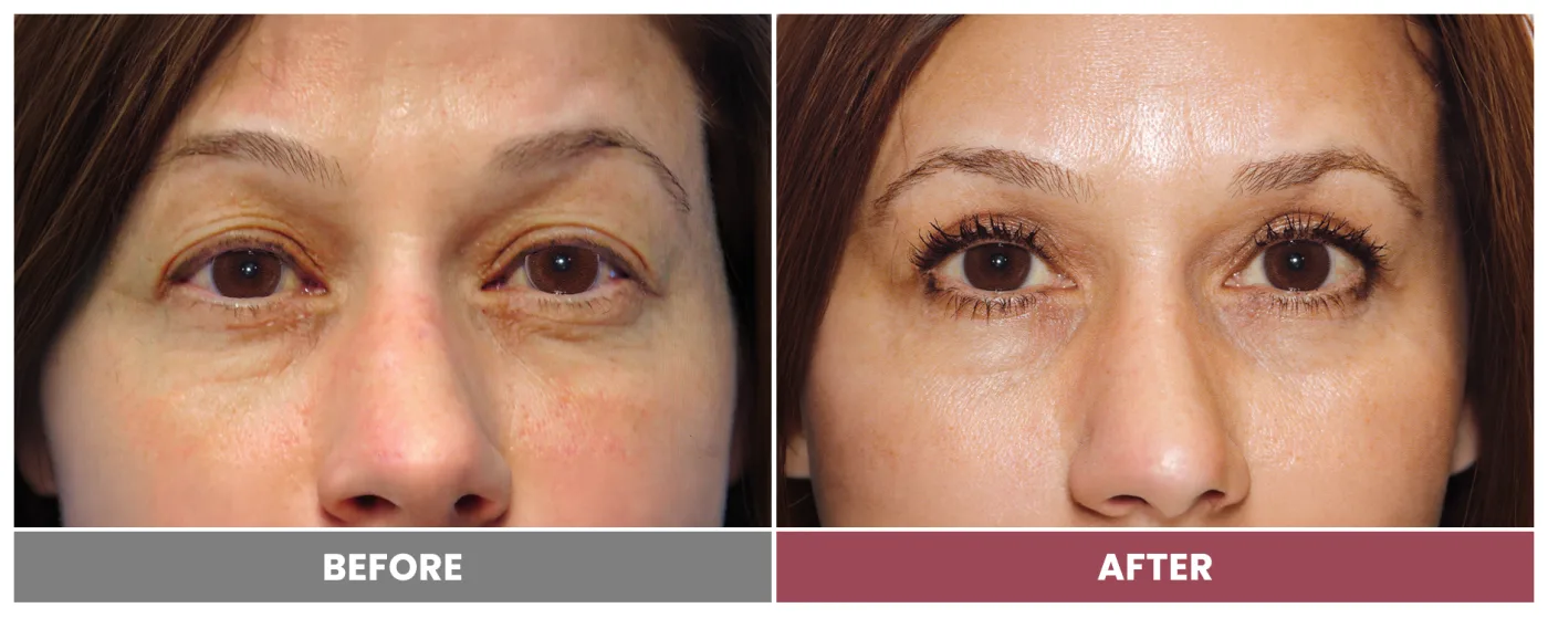Upper Blepharoplasty - Case 41
