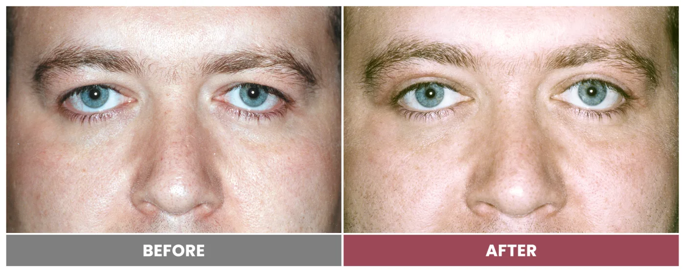 Upper Blepharoplasty - Case 42