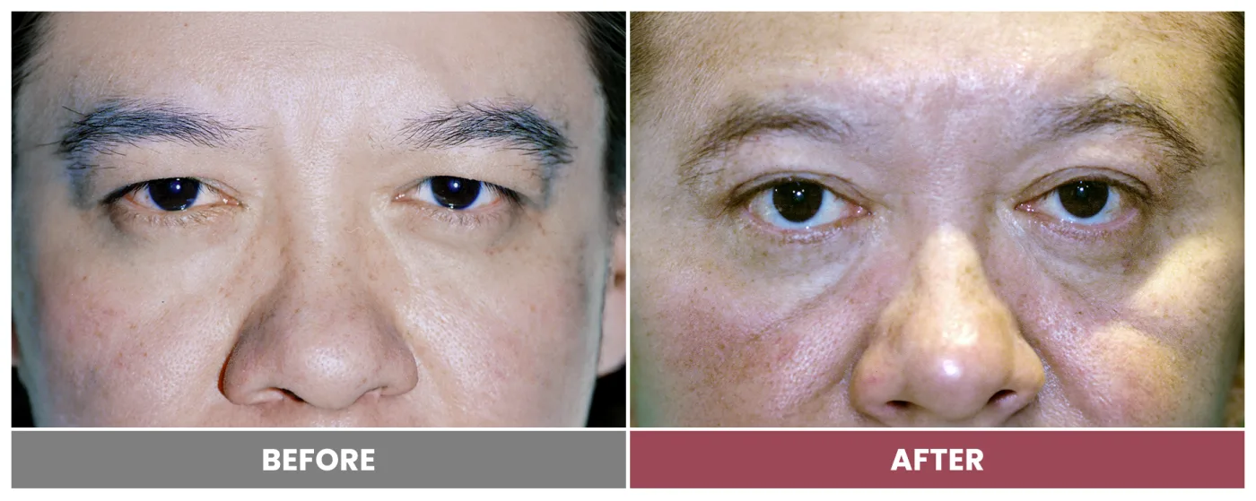 Upper Blepharoplasty - Case 43
