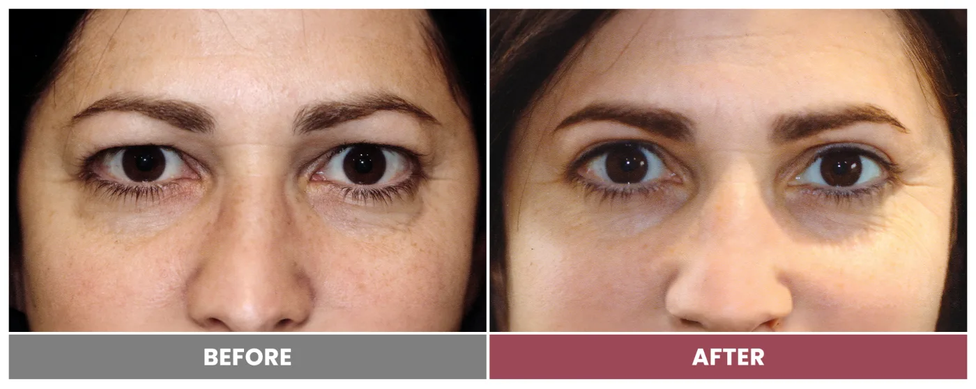 Upper Blepharoplasty - Case 44