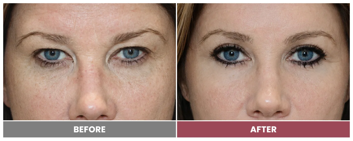 Upper Blepharoplasty - Case 48
