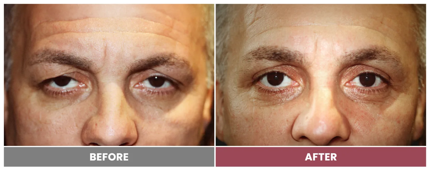 Upper Blepharoplasty - Case 49