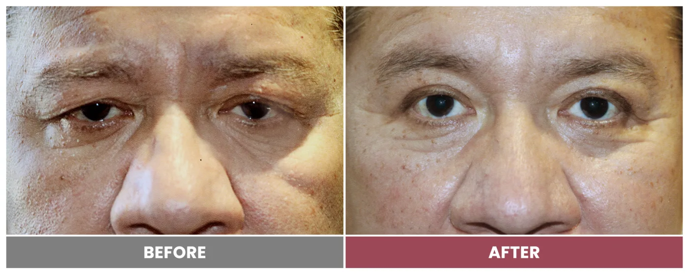 Upper Blepharoplasty - Case 5