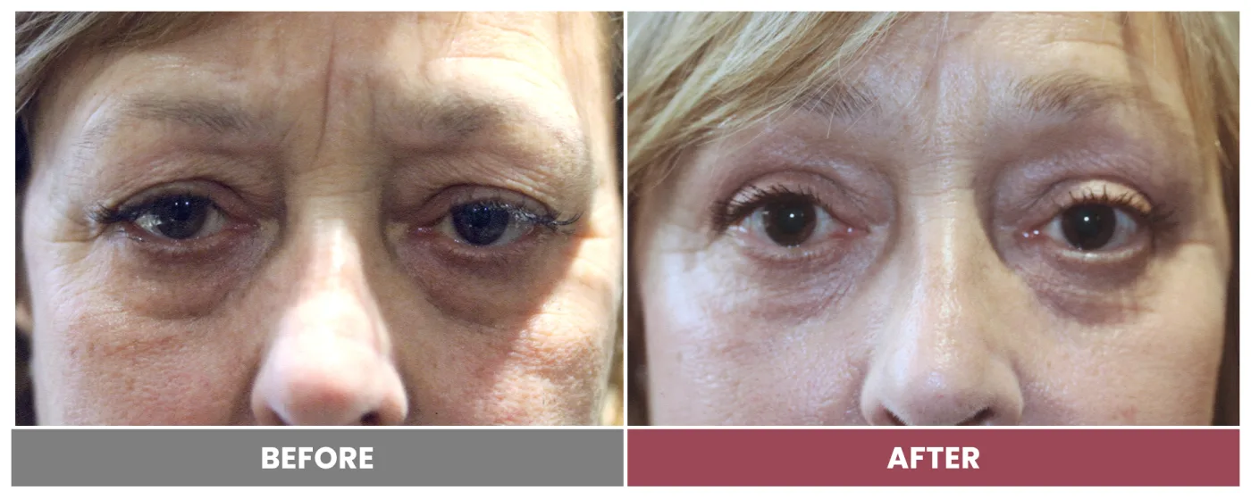 Upper Blepharoplasty - Case 53