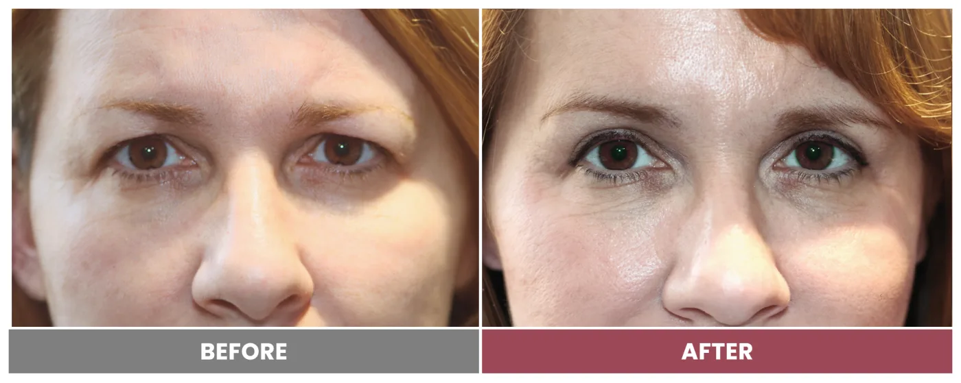 Upper Blepharoplasty - Case 55