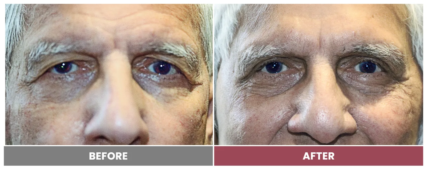 Upper Blepharoplasty - Case 57