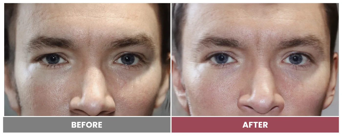 Upper Blepharoplasty - Case 58