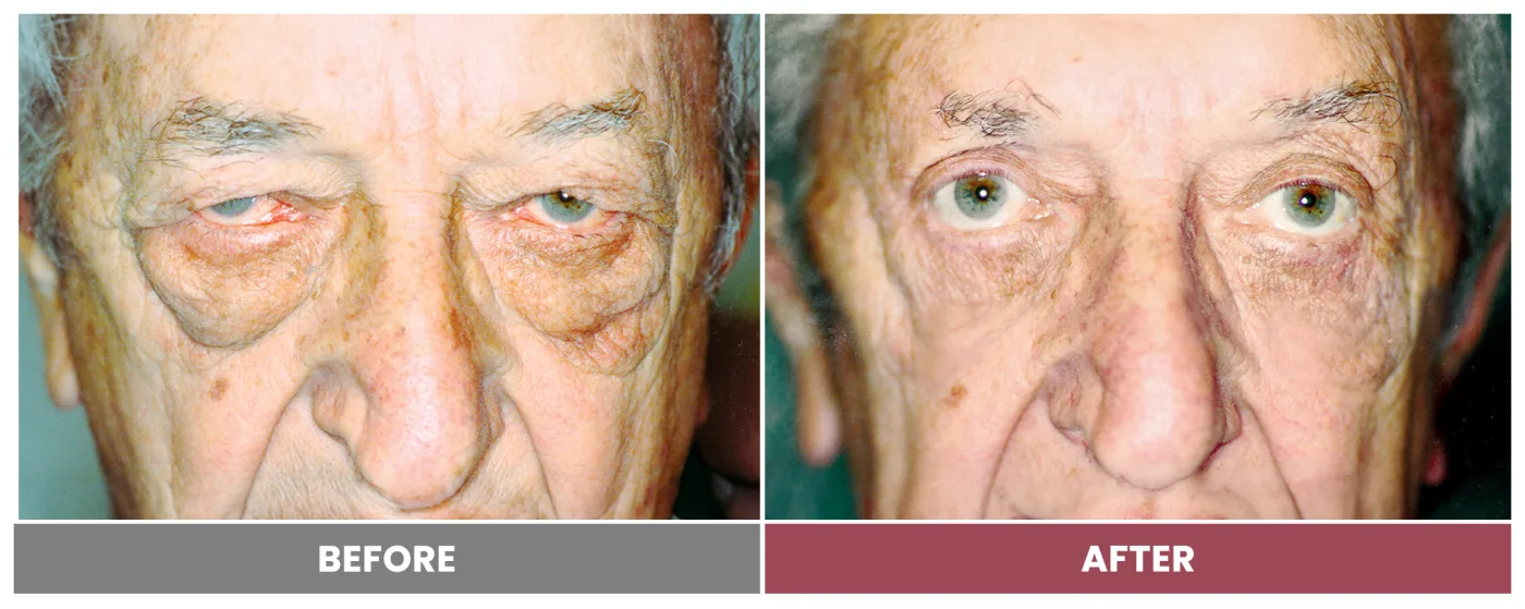 Upper Blepharoplasty - Case 60