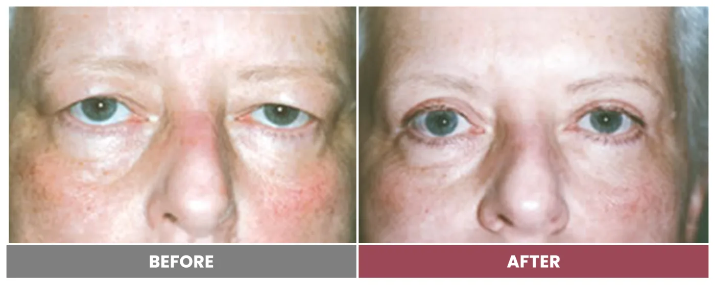 Upper Blepharoplasty - Case 62