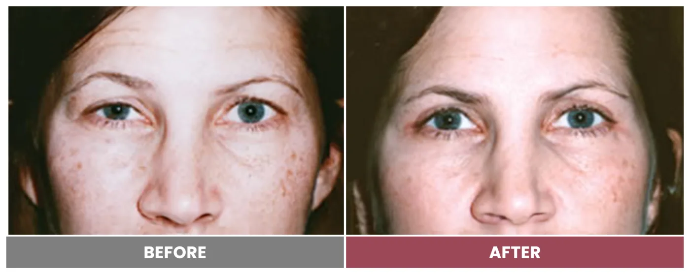 Upper Blepharoplasty - Case 64