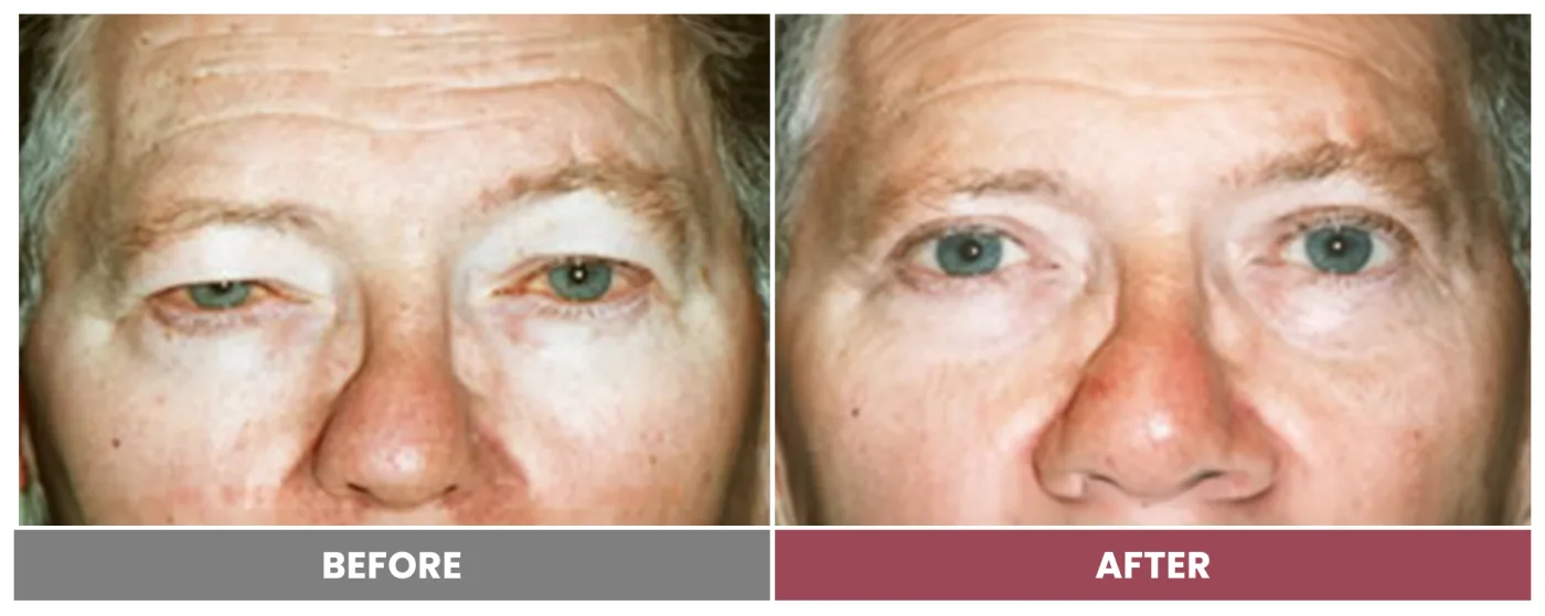 Upper Blepharoplasty - Case 66