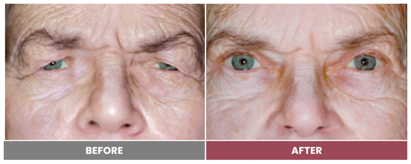 Upper Blepharoplasty - Case 67