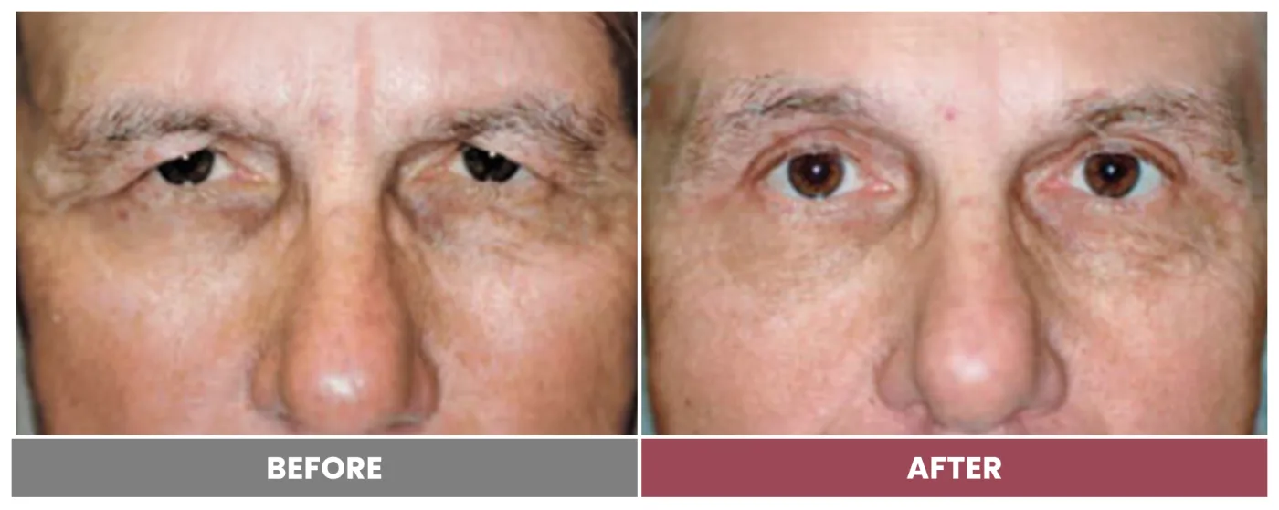 Upper Blepharoplasty - Case 68