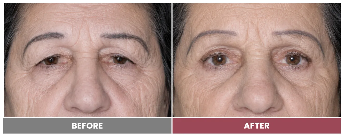 Upper Blepharoplasty - Case 71
