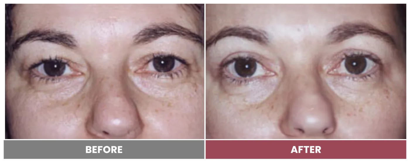 Upper Blepharoplasty - Case 74