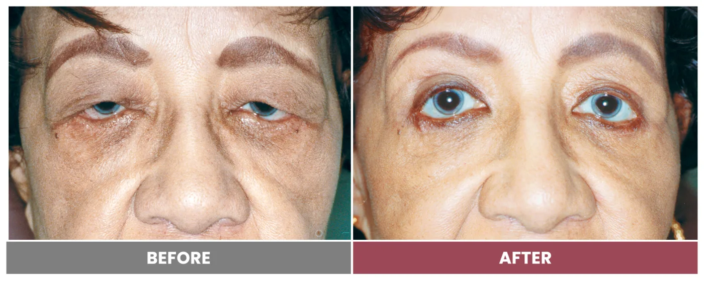 Upper Blepharoplasty - Case 77