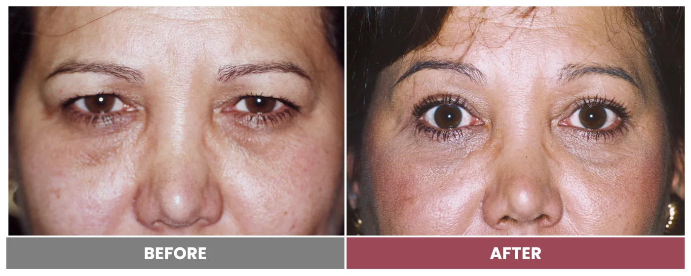 Upper Blepharoplasty - Case 78