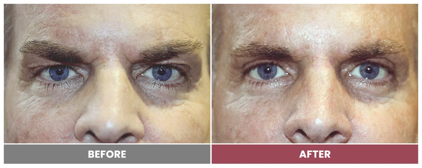 Upper Blepharoplasty - Case 8
