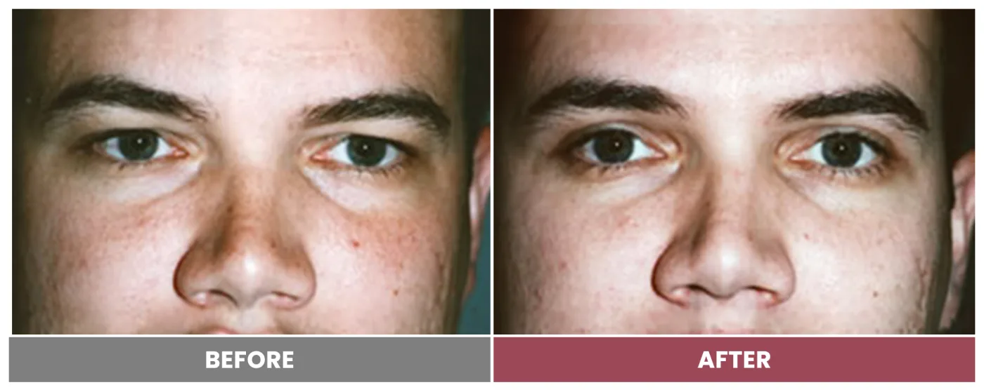 Upper Blepharoplasty - Case 80